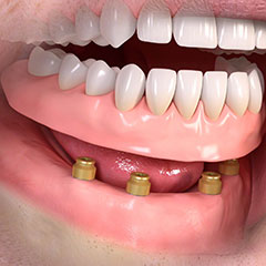 Zahnarzt Dr. Holger Peters in Rissen - Implantologie ©Straumann