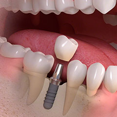 Zahnarzt Dr. Holger Peters in Rissen - Implantologie ©Straumann